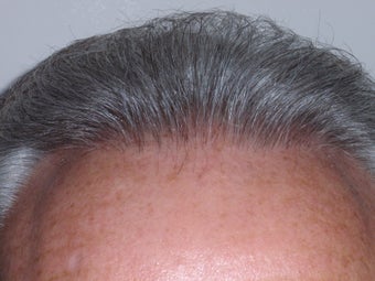 Hair Transplant