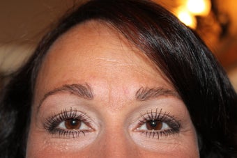 Eyebrow Transplantation