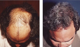 hair transplant