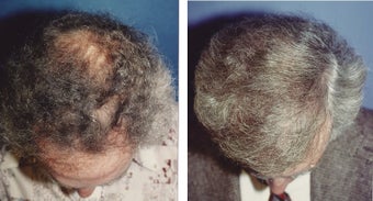 hair transplant