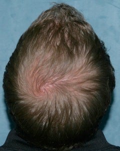 Hair transplant