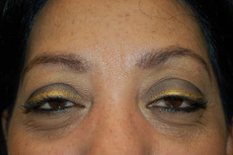 neograft brow transplant procedure