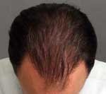 Hair Transplant