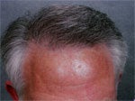 Hair Transplant