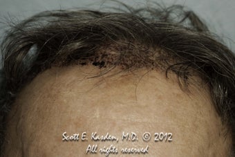 AccuGraft Hair Transplant