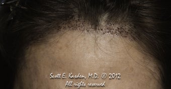 AccuGraft Hair Transplant