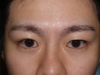 Eyebrow Transplant