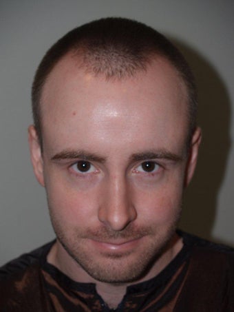 Hair Transplant