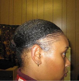 Hair Transplant 1400 Grafts