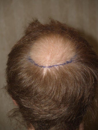 Hair Transplant 