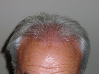 Hair Transplant