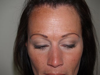 Eyebrow Transplantation