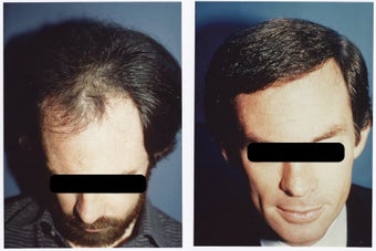 Hair Transplant