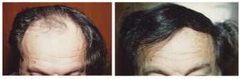 Hair Transplant