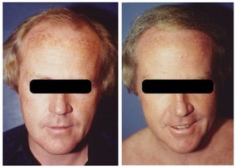 hair transplant