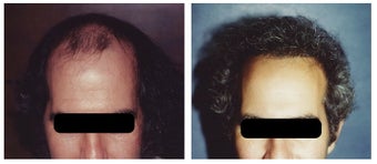 hair transplant
