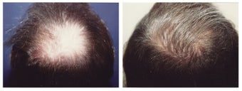 hair transplant