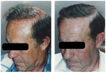 hair transplant