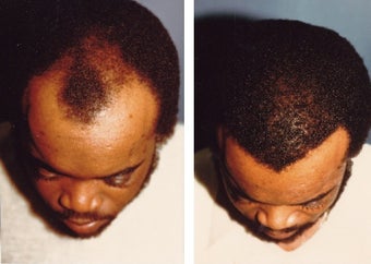 hair transplant
