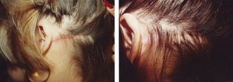 female hair transplant