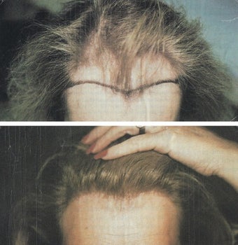 female hair transplant