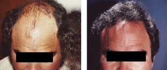 hair transplant