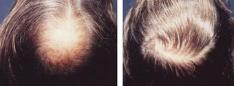 hair transplant
