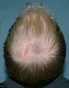 Hair transplant
