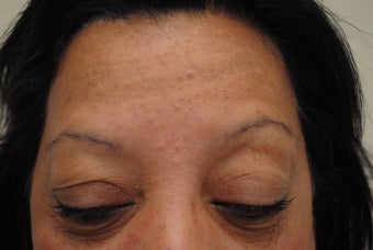 neograft brow transplant procedure