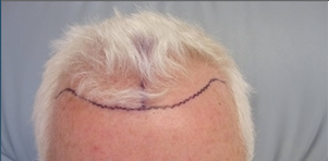 Hair Transplant