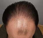 Hair Transplant