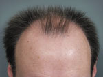 Hair Transplant