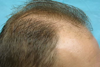 NeoGraft hair transplant