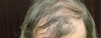 NeoGraft hair transplant