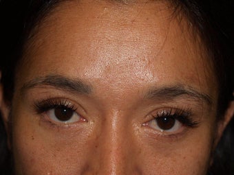 Before, Immediately After, and 1 Year After Eyebrow Transplant Procedure