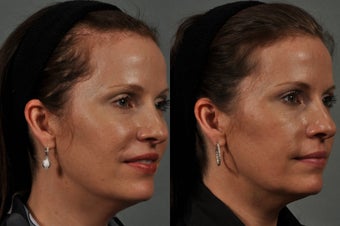 Hair Transplant Before & After