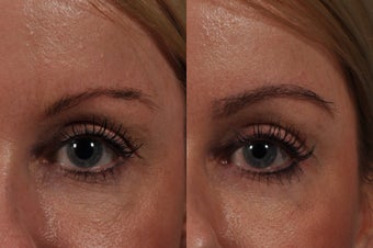 Eyebrow Hair Transplant