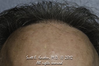 AccuGraft Hair Transplant