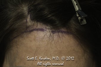 AccuGraft Hair Transplant