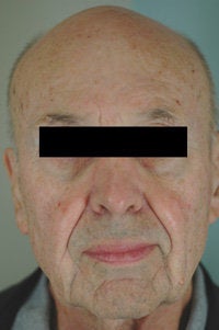 Pulsed Dye Laser Treatment for Rosacea 