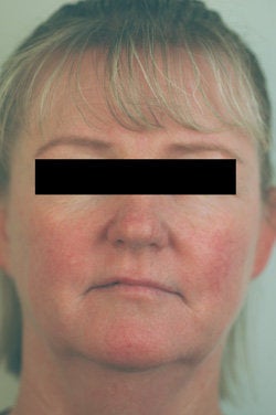 Rosacea and Facial Spider Veins