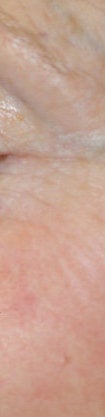 Spider hemangioma (blood freckle) laser treatments