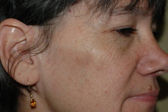 Sunspot removal with IPL