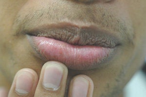 Brown Spots on the Lips