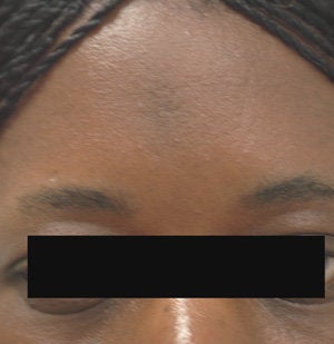 Scar Removal for Black Skin