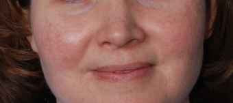 IPL Treatments