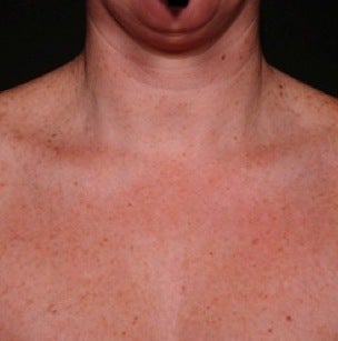 IPL for Chest