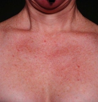 IPL for Chest