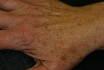 IPL laser for the hands