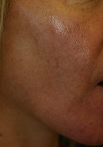 IPL for the face